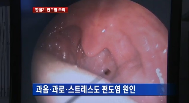 ▲급성편도염증상