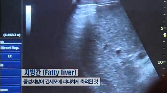 ▲지방간예방법(사진=유튜브영상캡처)