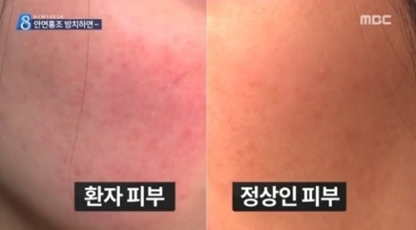 ▲안면홍조예방법(사진=MBC방송캡처)