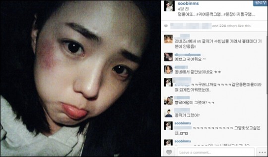 채수빈, 왼쪽 뺨에 '시퍼런' 멍자국이?