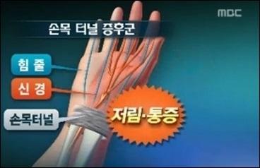 뻣뻣한 목 푸는 체조, '일상 속 통증' 손목터널증후군 자가진단법은?
