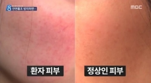 봄철 안면홍조, '홍당무 얼굴' 피하는 방법은