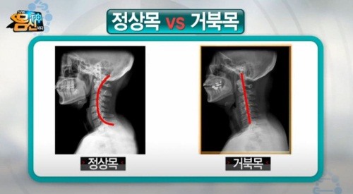 목건강 스트레칭, '거북목 예방' 간단 체조법