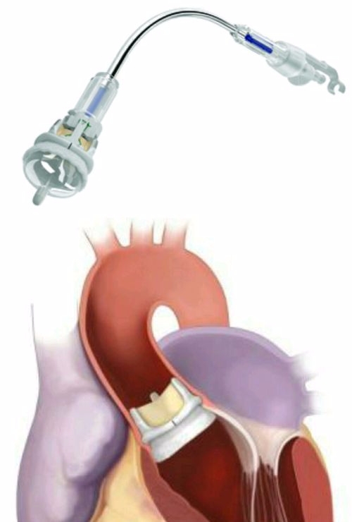 대동맥 판막증 수술에 사용되는 신속거치판막(RD판막) (사진:서울대병원제공)