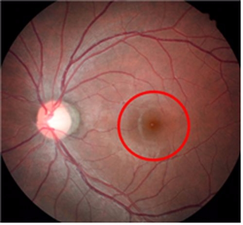 황반변성에 걸친 수정체 모습(사진=인제대 상계백병원 제공)