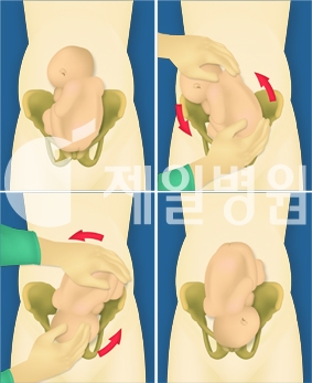 거꾸로 있는 태아 위치를 바로 잡는 역아회전술(사진= 제일병원)