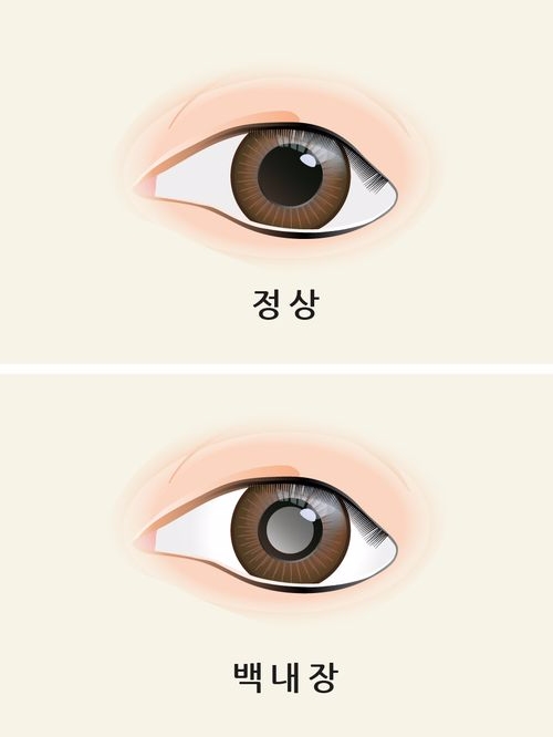 침침하고 뿌옇게 보이면 노안 아닌 이것 의심해야 한다