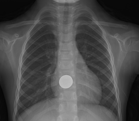 하부 식도에 걸린 직경 2cm의 10원 동전(사진=순천향대 부천병원 제공)