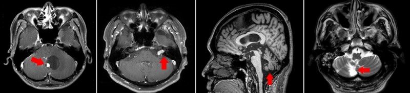 중추성 어지럼증의 유발질환 - 좌측부터 소뇌종양, 전정신경초종, 다발신경계위축증(퇴행성 뇌질환), 뇌경색 (사진=분당서울대)