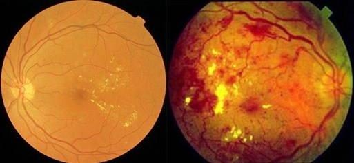 비증식 당뇨망막병증(좌), 증식당뇨망막병증(우) (사진=분당서울대병원)