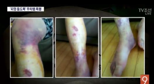 전공의 폭행, 이를 어찌할꼬...무자비한 방법에 분노글 이어져