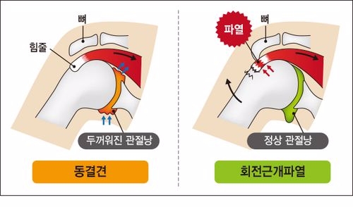 동결견 및 회전근개파열 비교(사진=강동경희대병원)