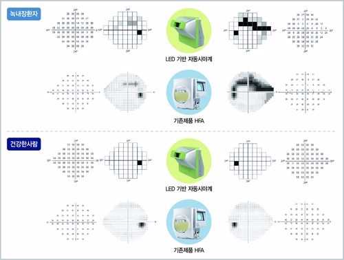 LED 기반 자동시야계와 기존제품(HFA)으로 녹내장 환자(A)와 건강한 사람(B)을 각각 검사한 결과 차이가 없음을 알 수 있다(사진=강동경희대병원)