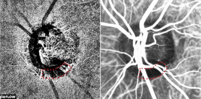 빛간섭단층 혈관조영검사(좌) 및 인도시아닌그린 혈관조영검사(우)로 얻은 녹내장 환자의 시신경유두 이미지. 붉은색 점선으로 둘러싸인 비관류 영역(혈류가 감소한 영역)이 일치한다.