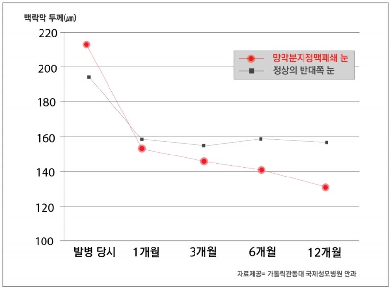 망막분지정맥폐쇄 맥락막 감소 관계 (사진=국제성모병원)