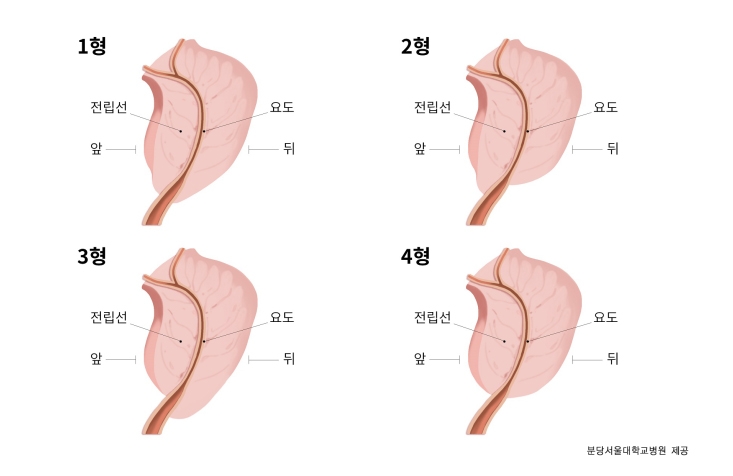 전립선 첨단부의 형태에 따른 분류 (사진=분당서울대병원)