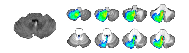 사진= 뇌 좌측 결절 부분에 뇌경색이 관찰되고 이로 인해 체위성 어지럼증/안진을 보인 환자의 MRI (좌측), 여러 환자들의 뇌병변 지도를 겹쳐 체위성 어지럼증/안진이 생기는 위치를 확인한 그림 (우측). 