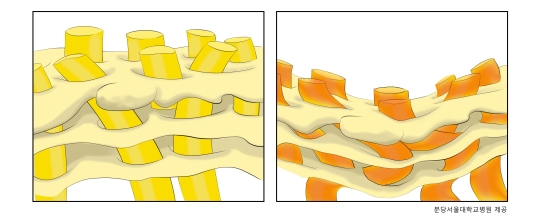 그림2. (좌) 사상판을 통해 시신경섬유(노란색 기둥) 다발이 지나가는 모양과 (우) 사상판이 압착되어 시신경섬유가 손상된 모습 