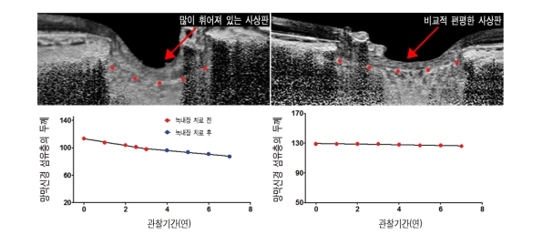 그림3. 사상판이 휘어진 환자의 경우에는 계속해서 망막신경 섬유층이 손상되었던 반면, 편평한 사상판을 가진 환자의 경우에는 망막신경 섬유층의 손상이 거의 나타나지 않았다.