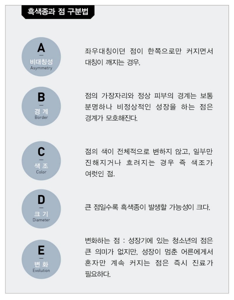 흑색종과 점 구분법 (사진=상계백병원 제공)
