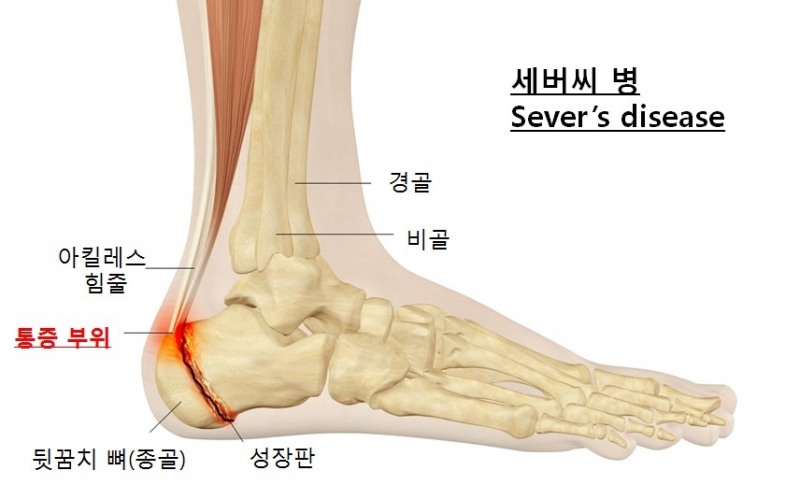 세버씨병 통증부위 (사진=서울백병원)