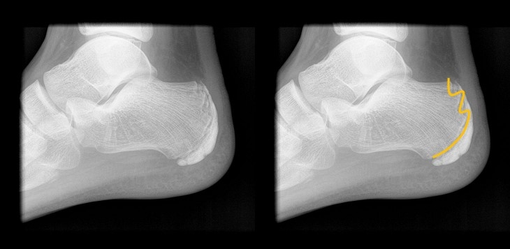 세버씨병 방사선 (사진=서울백병원)