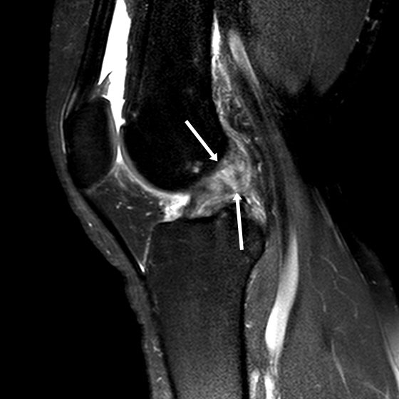 전방십자인대가 파열된 환자의 MRI 영상 (사진=인천성모병원)