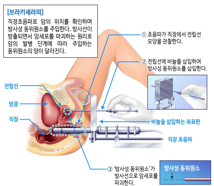 첨부. 브라키테라피 수술 모식도. (사진=분당차병원)
