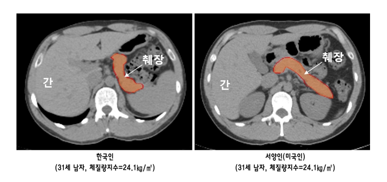 한국인과 서양인의 췌장 기능 비교, 같은 나이 동일 체형에서 서양인에 비해 한국인의 췌장 기능이 36.5% 낮은 것으로 확인됐다. (사진=분당서울대병원)
