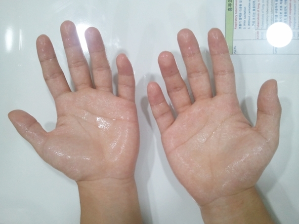 손에서만 땀이 많이 나는 국소다한증 환자의 손. (사진=인천성모병원)