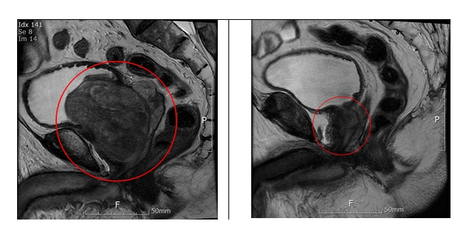 전립선암이 동반된 거대 전립선 환자와 보통 남성의 전립선 MIR 비교 (사진=분당차병원)