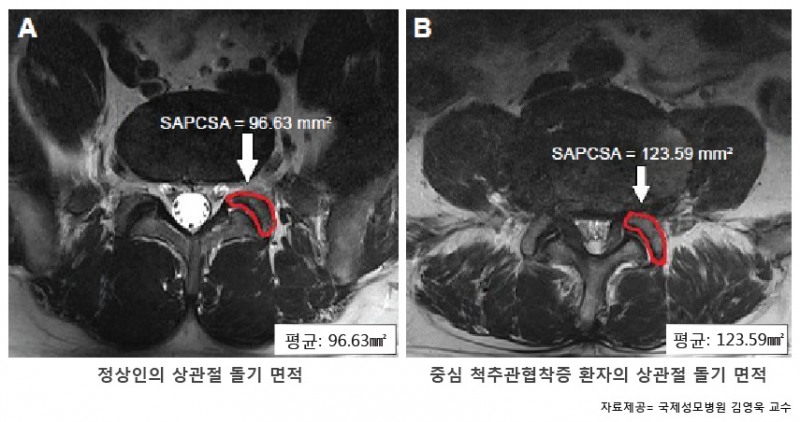(사진=연구결과(MRI 영상 비교)