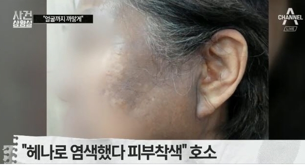 사진= 헤나염색 부작용 채널에이 보도화면