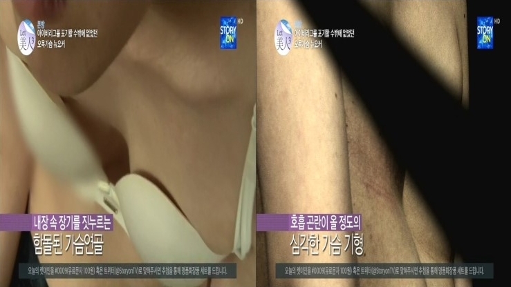 사진= 오목가슴 사례