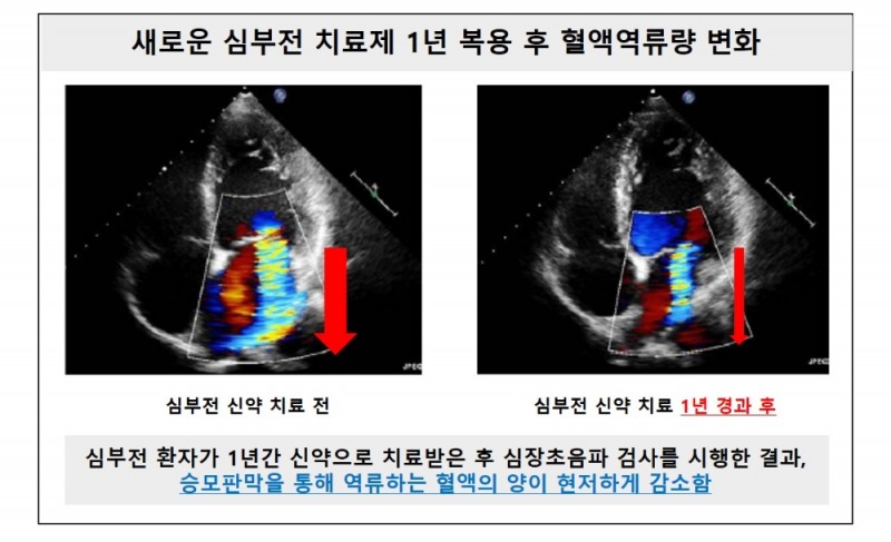 사진=새로운 심부전 치료제 1년 복용 후 혈액역류량 변화