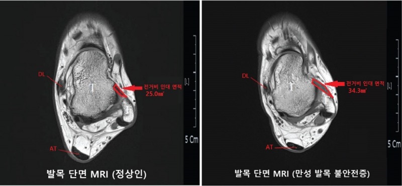 발목 단면 MRI 비교 (사진=국제성모병원)