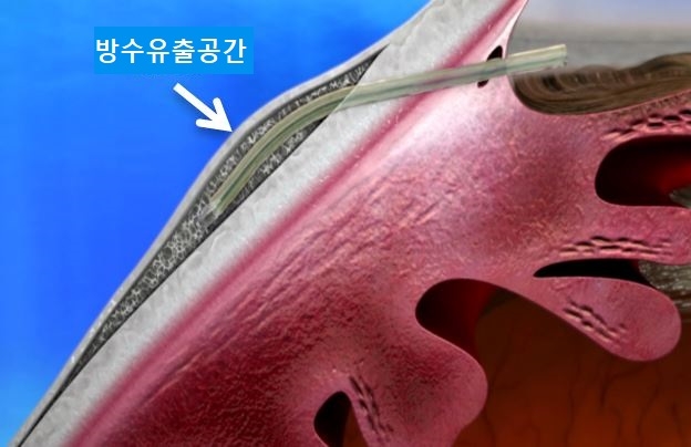 녹내장 스텐트 삽입술 (사진=분당차병원)