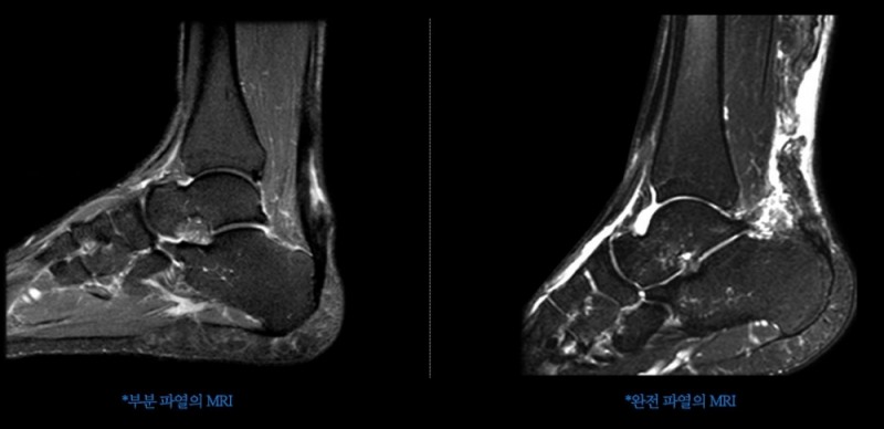 아킬레스건이 뭐길래, 잘나가던 아이돌이 돌연 하차