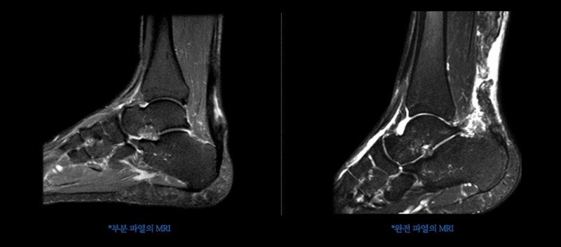 '뭉쳐야 찬다'로 부는 조기축구 열풍, 이것만은 조심해야