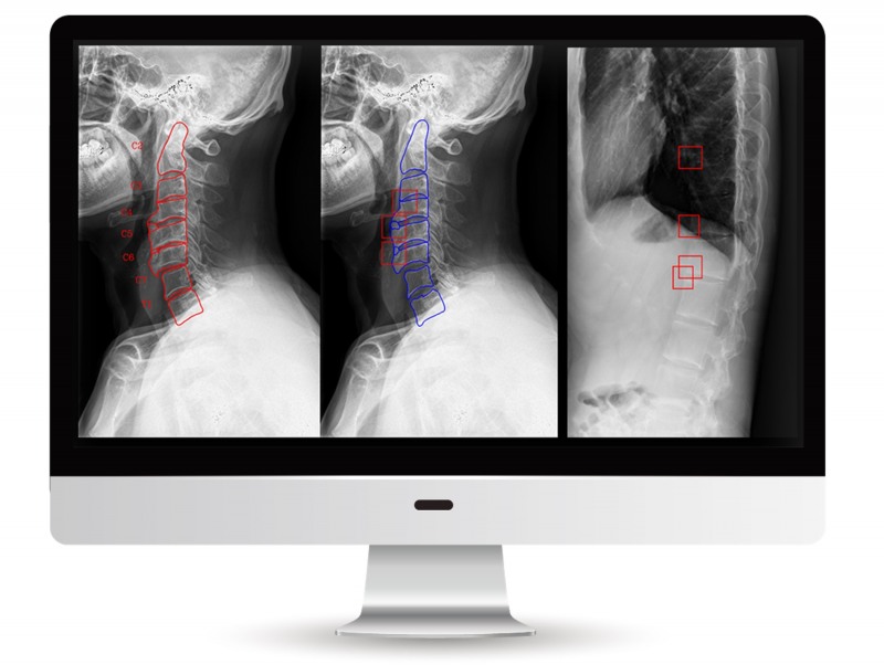 딥노이드, AI알고리즘 통한 ‘강직성 척추염’ 연구결과 발표