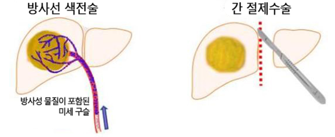 서울대병원, 방사선색전술 1500례 달성