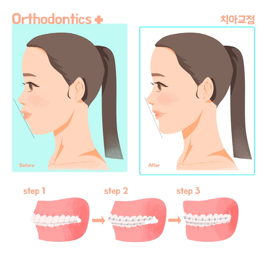 (사진=아이디치과 제공)
