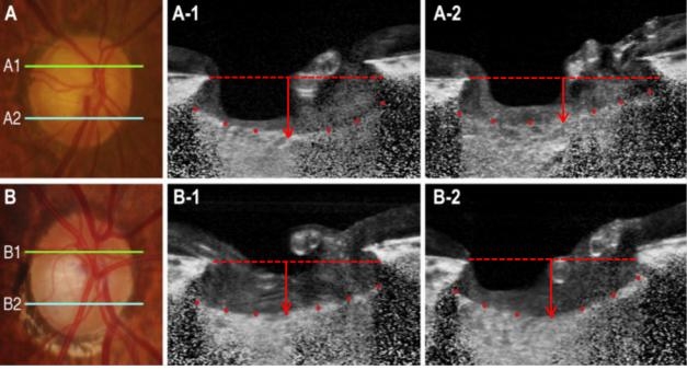 A는 위쪽 시신경이 손상된 환자, 위쪽 사상판(A-1)이 아래쪽 사상판(A-2)보다 더 휘어져 있다. B는 아래쪽 시신경이 손상된 환자, 아래쪽 사상판(B-2)이 위쪽 사상판(B-1)보다 더 휘어져 있다. (그림=분당서울대병원)