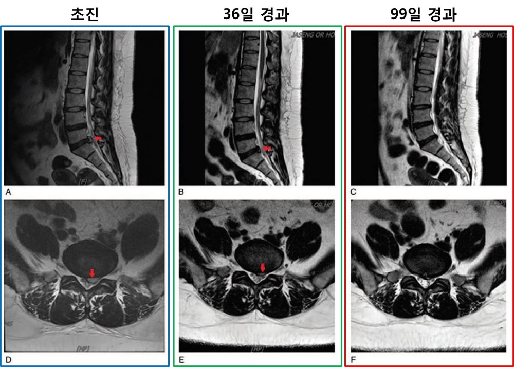 자생한방병원 척추관절연구소, 디스크 낭종에 대한 한∙양방 비수술 통합치료 증례보고