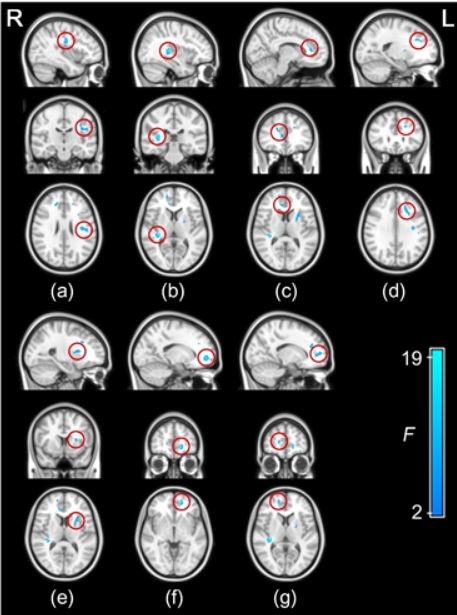 분당서울대병원 "수면무호흡증 방치했다간 뇌 기능 떨어지고 뇌 조직 손상돼"