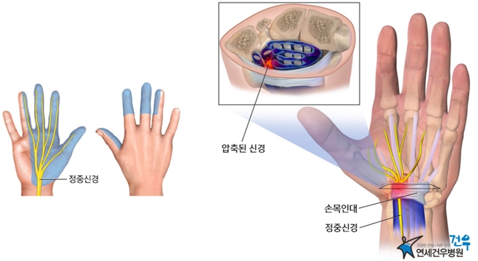 ‘애미야 전 부쳐라’ 명절증후군 손목 터널 증후군·테니스 엘보