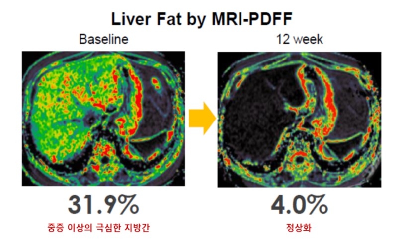 한미 LAPSTriple Agonist, 글로벌 시장 ‘게임체인저’ 예고