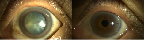 백내장(좌) 및 백내장 수술 후 모습(우). 사진=인천성모병원