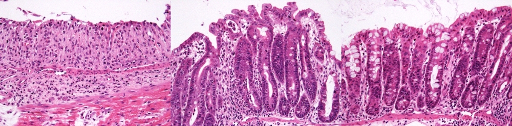 퓨젠바이오, 크론병 혁신 신약 후보물질 개발