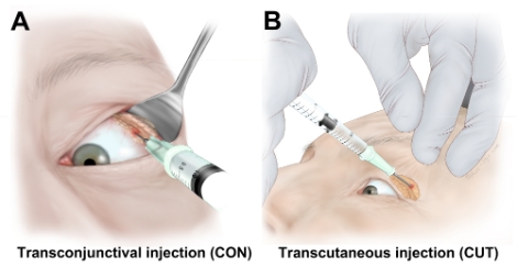 건국대병원, 보톡스 이용 눈물흘림치료 성공률 90% 달성